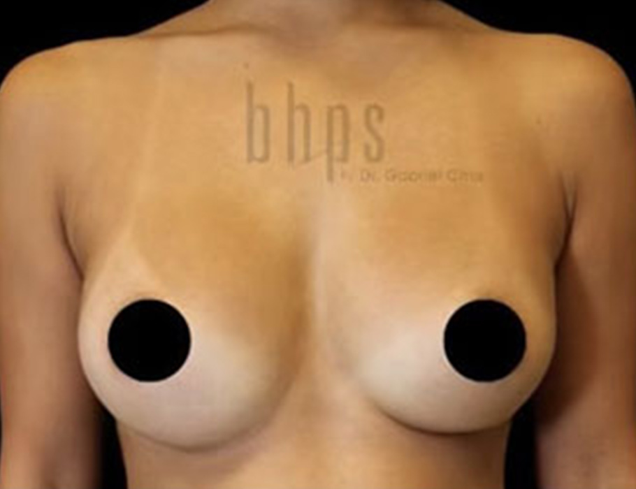 Case--9275 | After Breast Augmentation