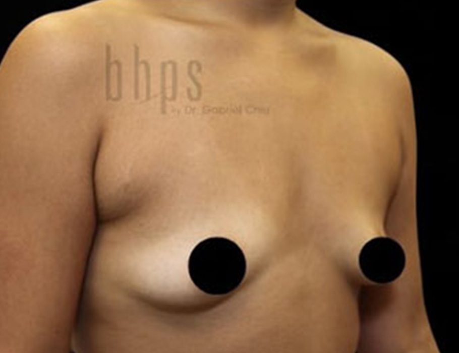 Case--9275 | Before Breast Augmentation 2