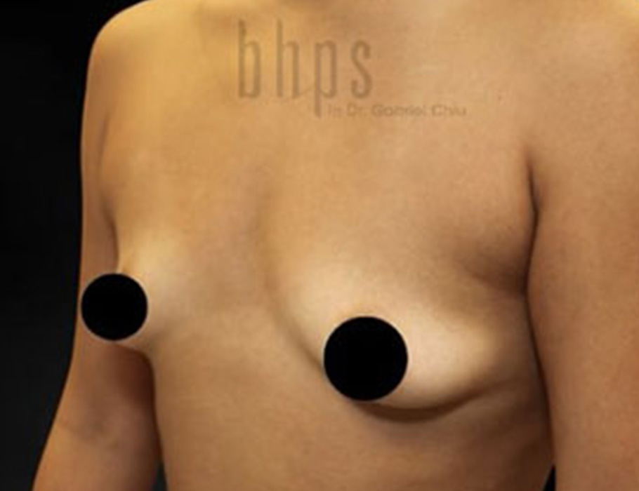 Case--9275 | Before Breast Augmentation 3