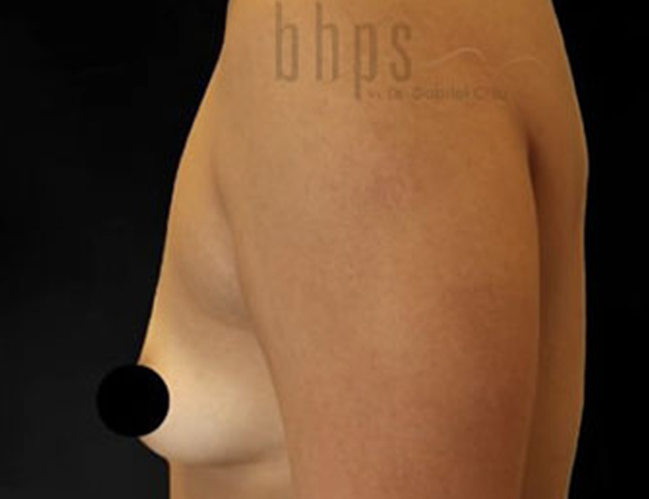 Case--9275 | Before Breast Augmentation 4