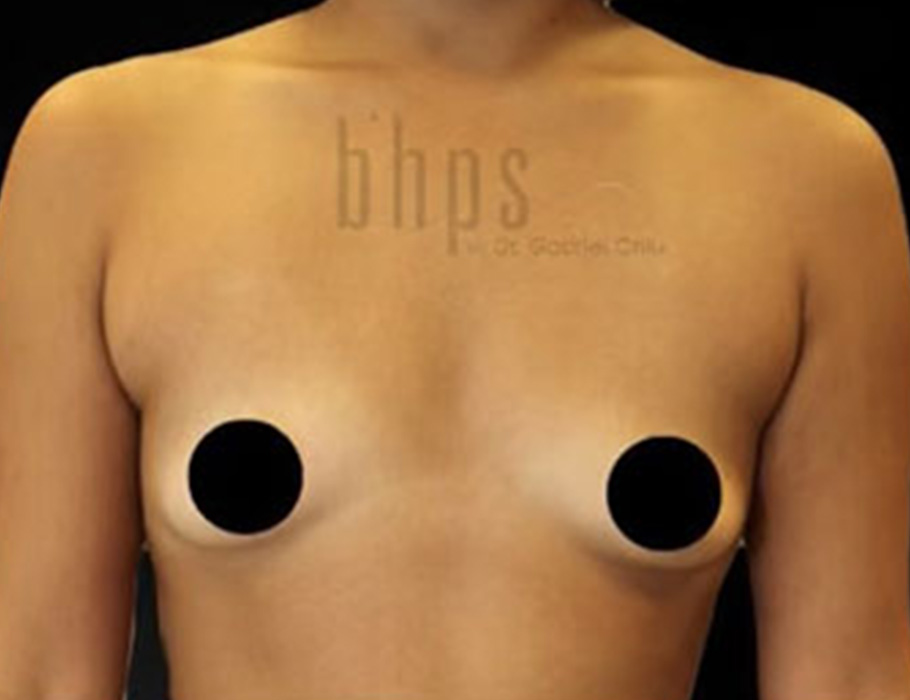 Case--9275 | Before Breast Augmentation