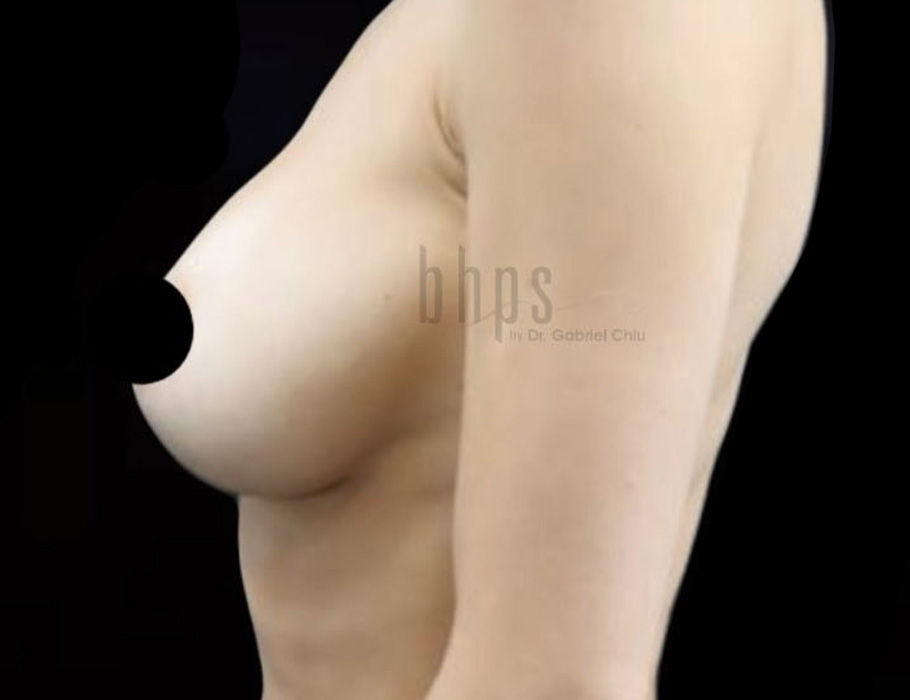 Case--8243 | After Breast Augmentation 4