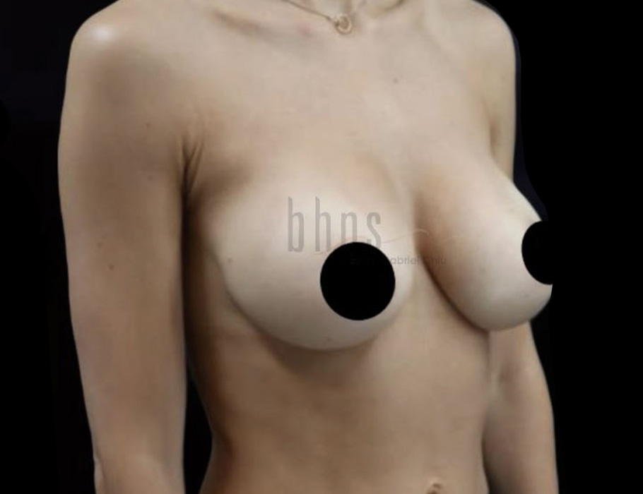 Case--8243 | After Breast Augmentation 5