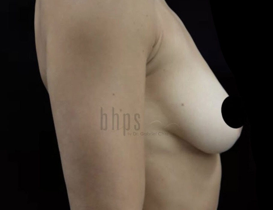 Case--8243 | Before Breast Augmentation 2