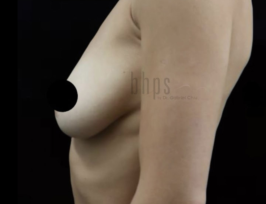 Case--8243 | Before Breast Augmentation 4