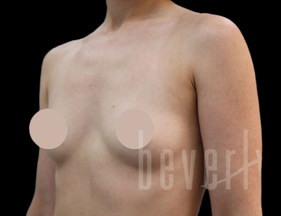Case--9258 | Before Breast Augmentation