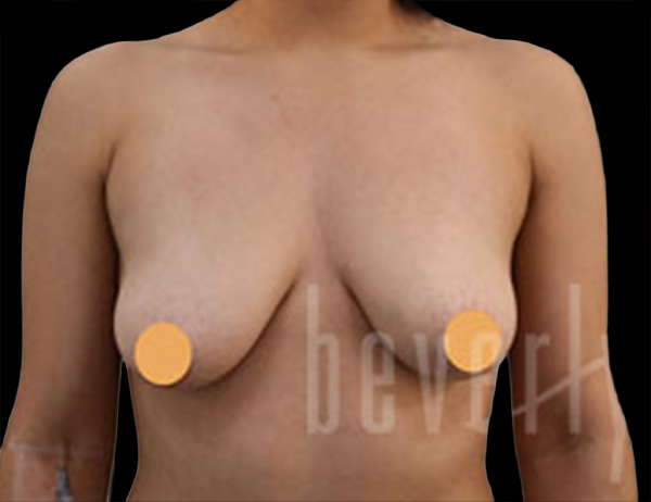 Case--3620 | Before Breast Augmentation