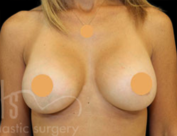 Case--5250 | After Breast Augmentation