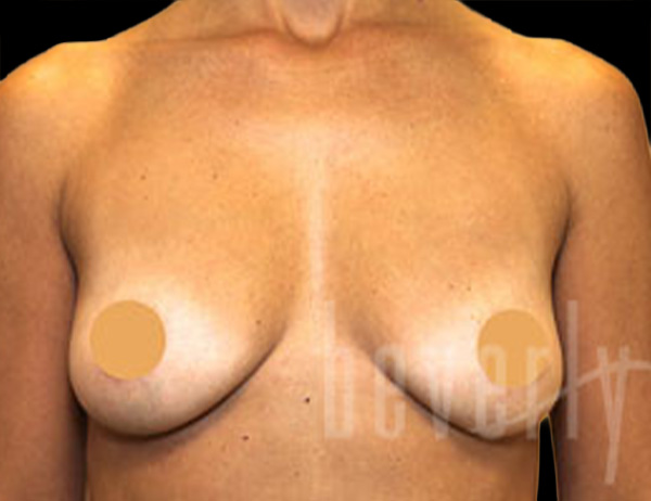 Case--5250 | Before Breast Augmentation