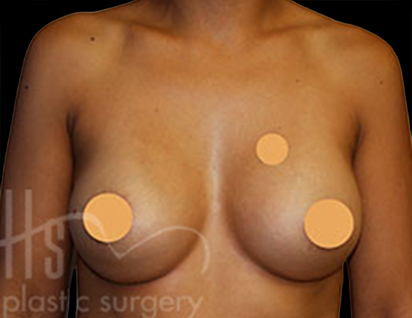 Case--5046 | After Breast Augmentation