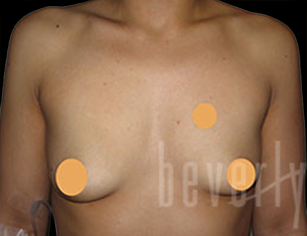 Case--5046 | Before Breast Augmentation
