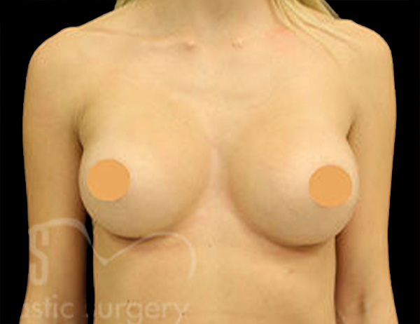 Case--8191 | After Breast Augmentation