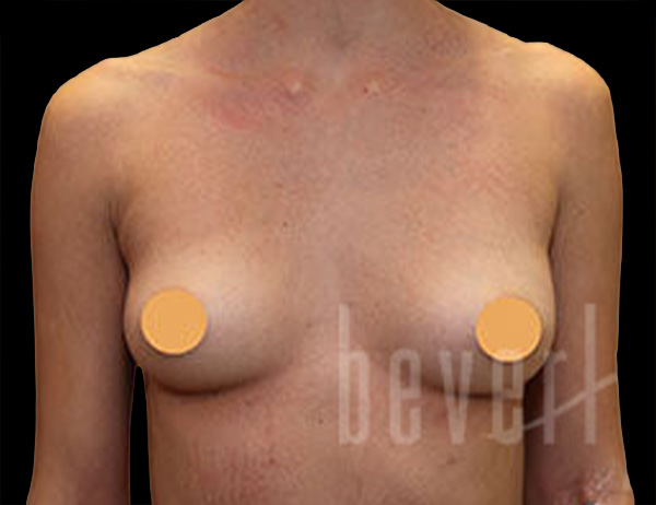 Case--8191 | Before Breast Augmentation