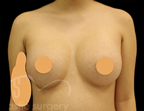 Case--9807 | After Breast Augmentation