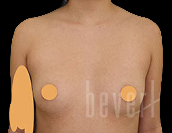 Case--9807 | Before Breast Augmentation