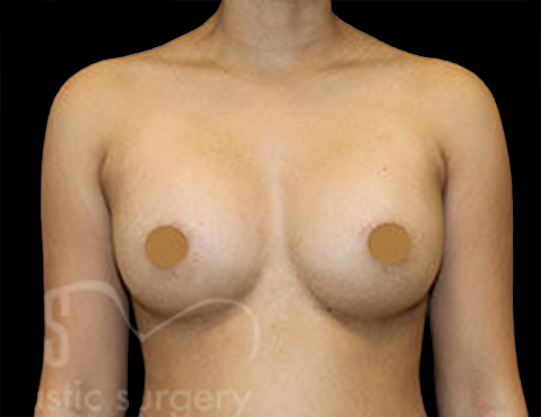Case--7111 | After Breast Augmentation
