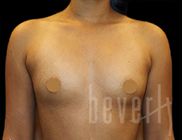 Case--7111 | Before Breast Augmentation