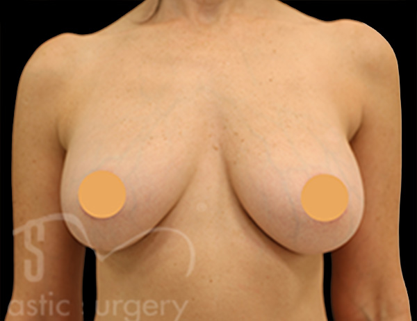 Case--3700 | After Breast Augmentation