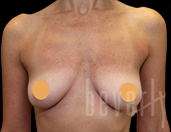 Case--3700 | Before Breast Augmentation