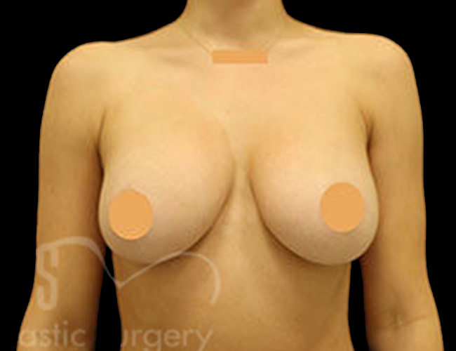 Case--1752 | After Breast Augmentation