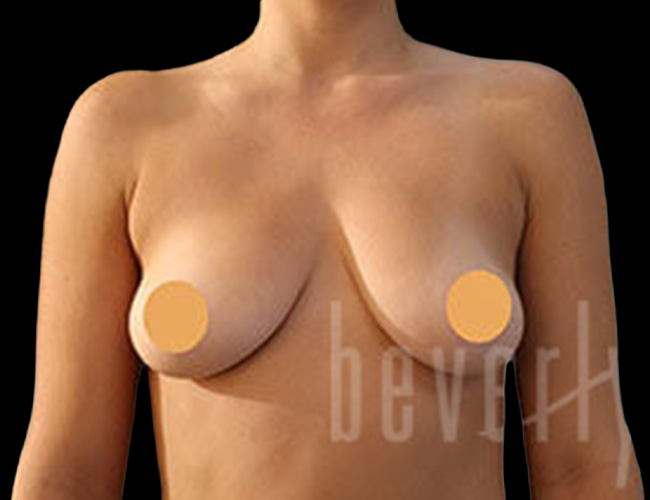 Case--1752 | Before Breast Augmentation