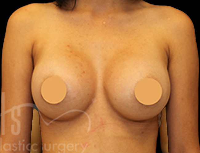 Case--2501 | After Breast Augmentation