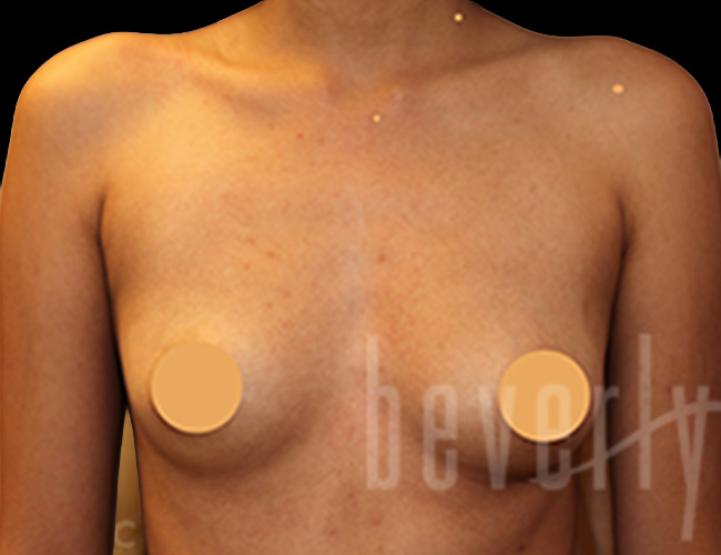 Case--2501 | Before Breast Augmentation