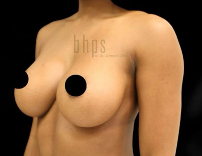 Natural Breast Augmentation Patient After - 2