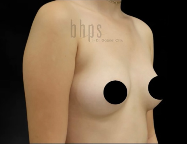Case--2719 | Before Breast Augmentation 2
