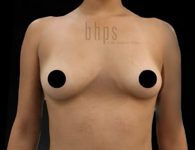 Case--4591 | Before Breast Augmentation