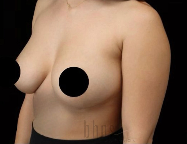 Case--8942 | After Breast Augmentation 2