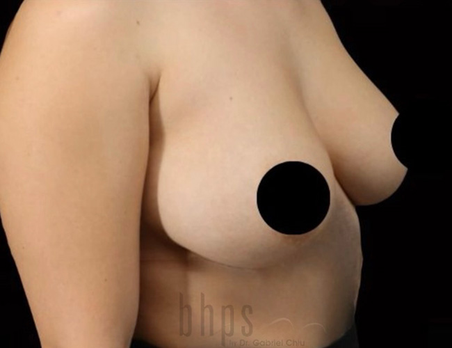 Case--8942 | After Breast Augmentation 4