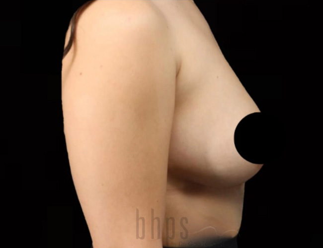 Case--8942 | After Breast Augmentation 5