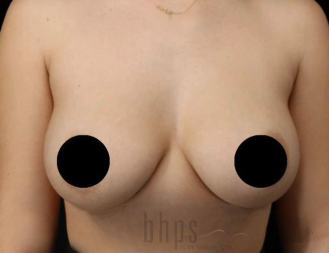 Case--8942 | After Breast Augmentation