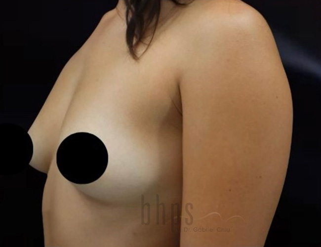 Case--8942 | Before Breast Augmentation 2