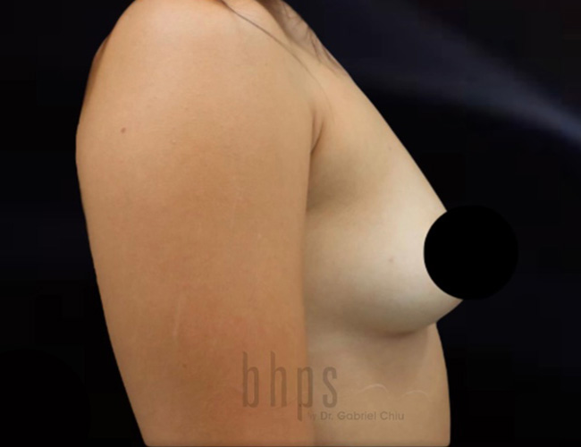 Case--8942 | Before Breast Augmentation 5