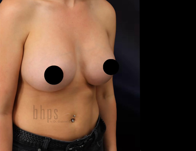 Case--6375 | After Breast Augmentation 2