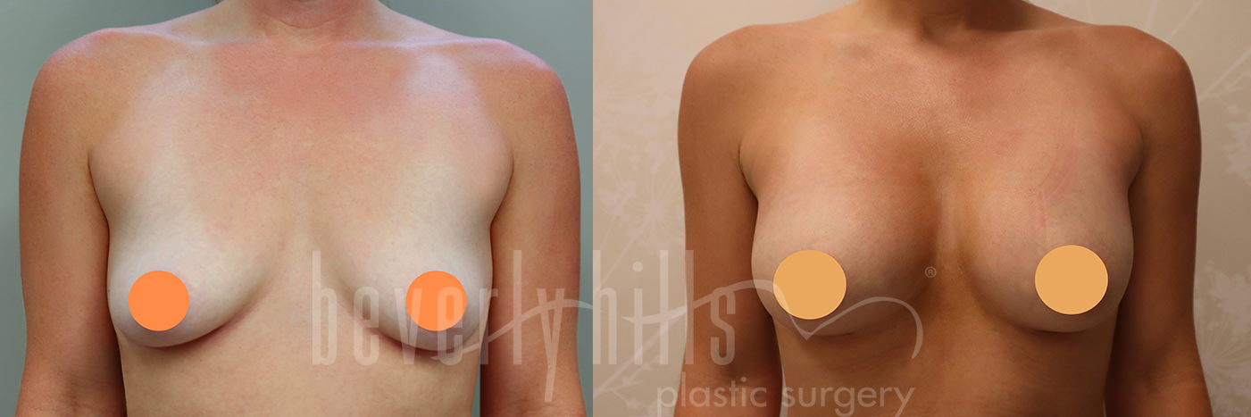 Breast Augmentation Patient 98 Before & After