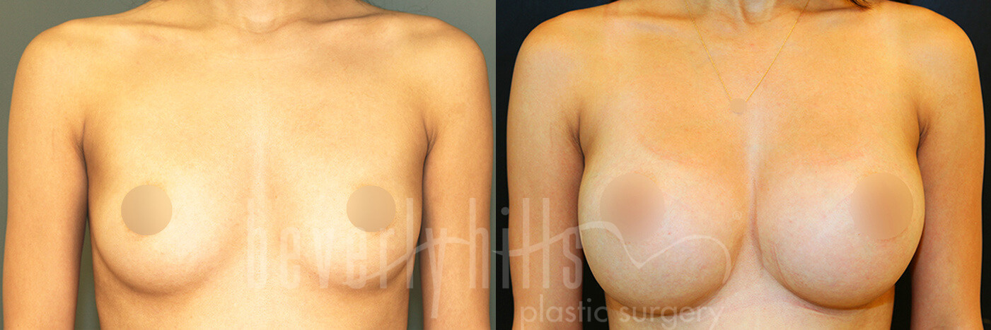 Breast Augmentation 107 Before & After