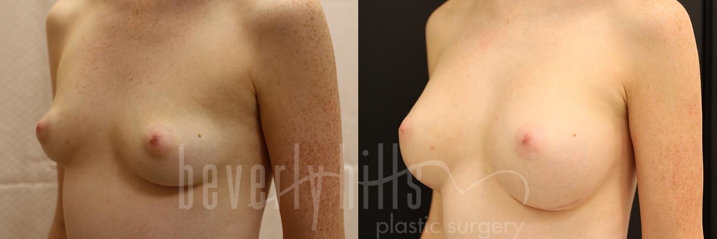Breast Augmentation 75 Before & After