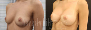 Breast Augmentation 76 Before & After - Thumbnail