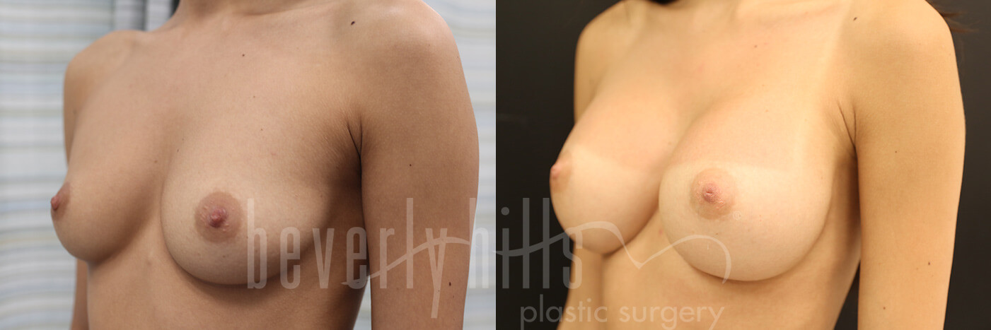 Breast Augmentation 76 Before & After