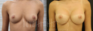 Breast Augmentation 76 Before & After - Thumbnail