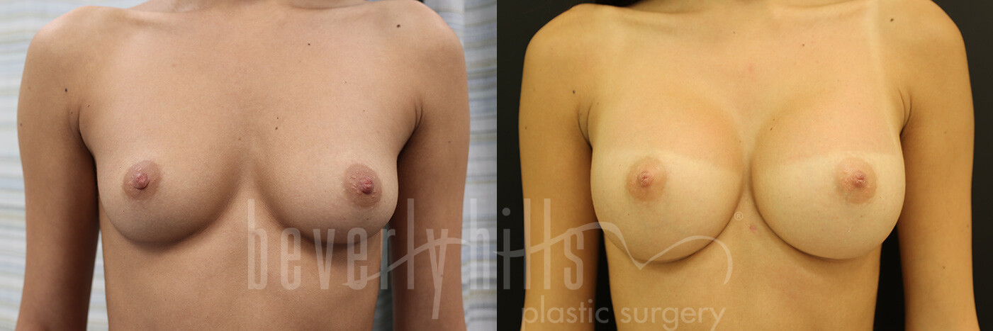 Breast Augmentation 76 Before & After