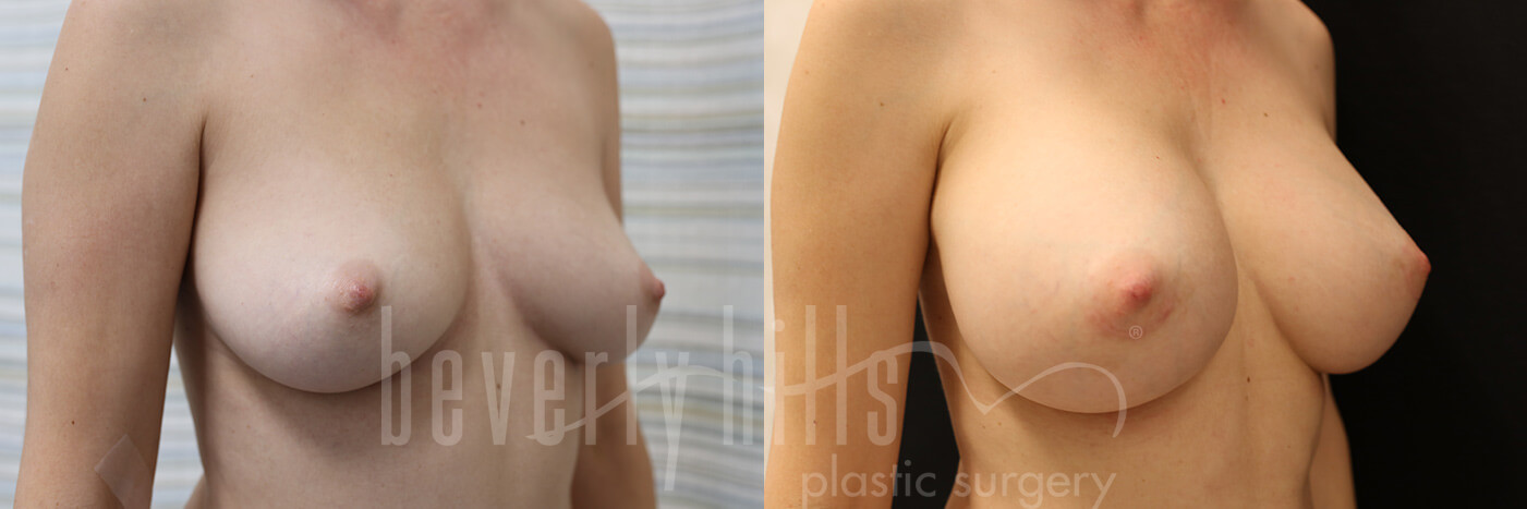 Breast Augmentation 77 Before & After