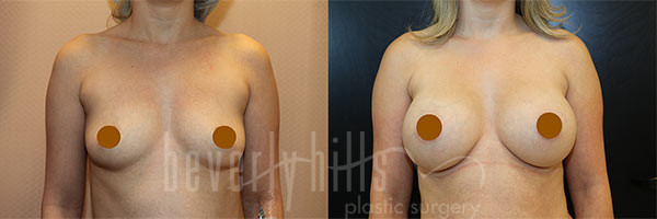 Breast Augmentation 78 Before & After