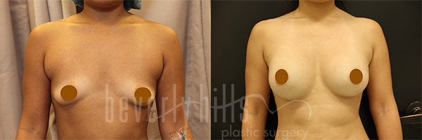 Breast Augmentation 79 Before & After