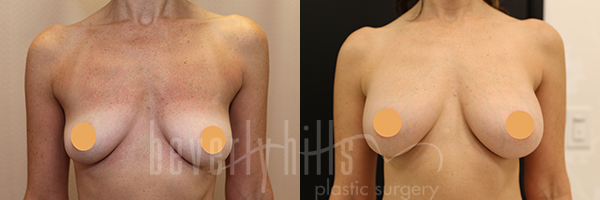 Breast Augmentation Patient 87 Before & After