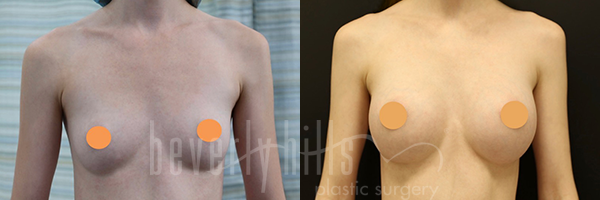 Breast Augmentation Patient 96 Before & After