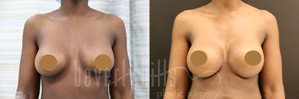 Breast Augmentation Patient 97 Before & After